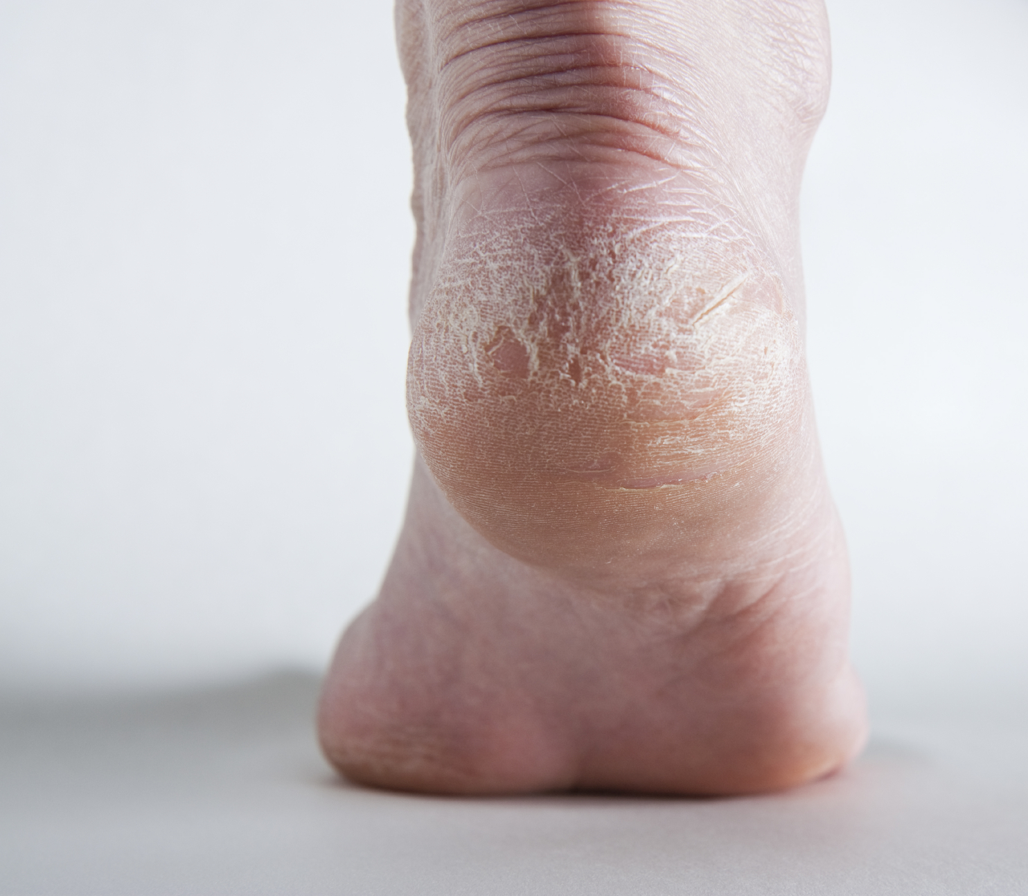 Cracked Heels and Vitamin Deficiency - Is There a Connection? – Delfina  Skin™
